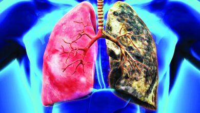 Photo of ফুসফুসের ক্যান্সারের ঝুঁকিতে আছেন? জানিয়ে দিবে ৫ লক্ষণ