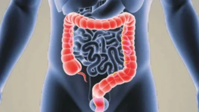 Photo of কোলন ক্যান্সার কীভাবে বুঝবেন